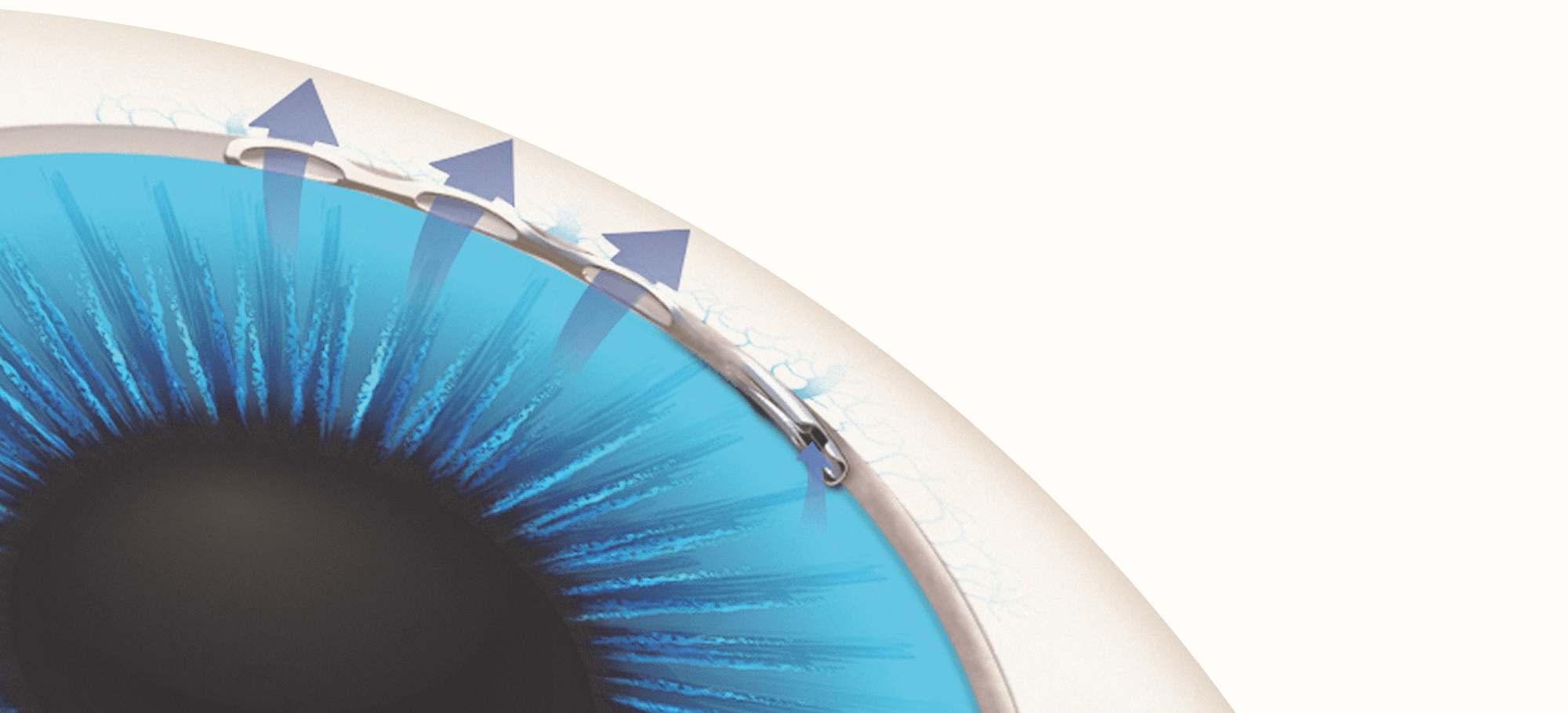 Hydrus Microstent MIGS: An Easier Method for Glaucoma 