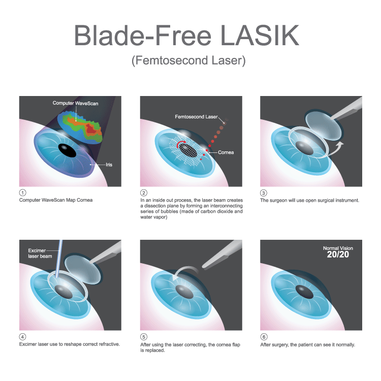 Blade-Free LASIK Chart