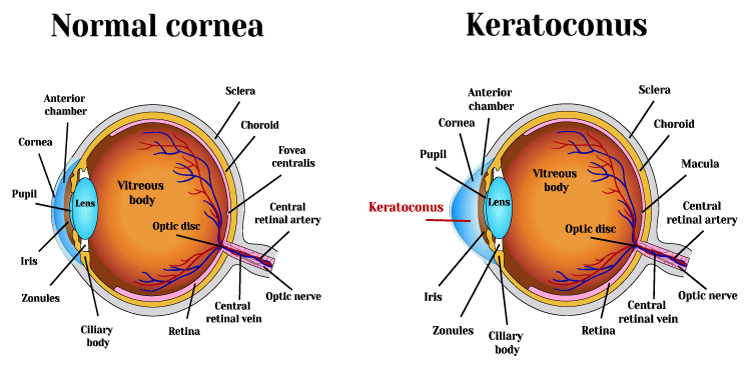 Keratoconus Chart