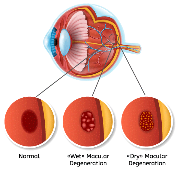 Macular Degeneration Chart Macular Degeneration Chart