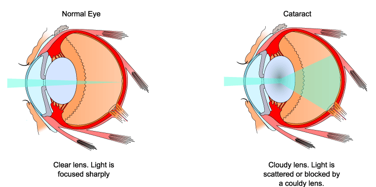 Normal Eye vs Eye With Cataracts Cataract chart