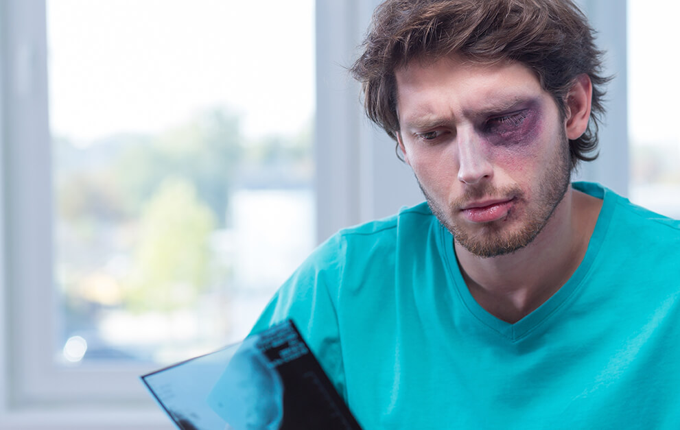 Man with black eye looking at x ray