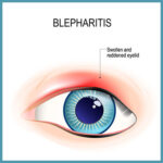 blepharitis treatment buffalo ny