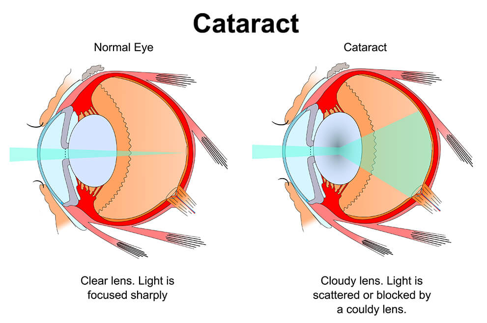 cataract-diagram.jpg