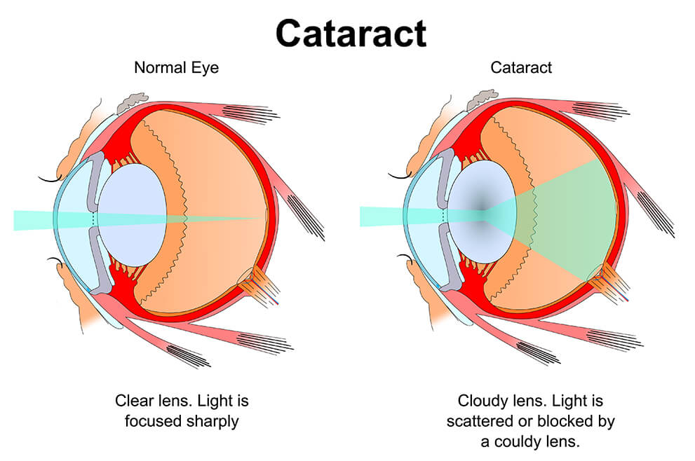 Cataract Diagram