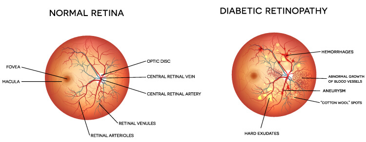 Diabetic Retinopathy