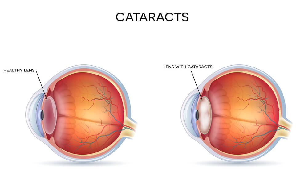 Healthy Lens vs Lens with Cataracts